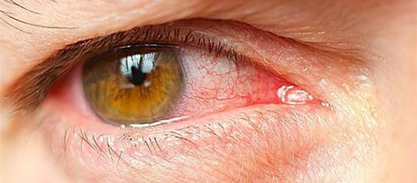 Δείτε τι πρέπει να κάνετε για να αποφύγετε την εαρινή επιπεφυκίτιδα